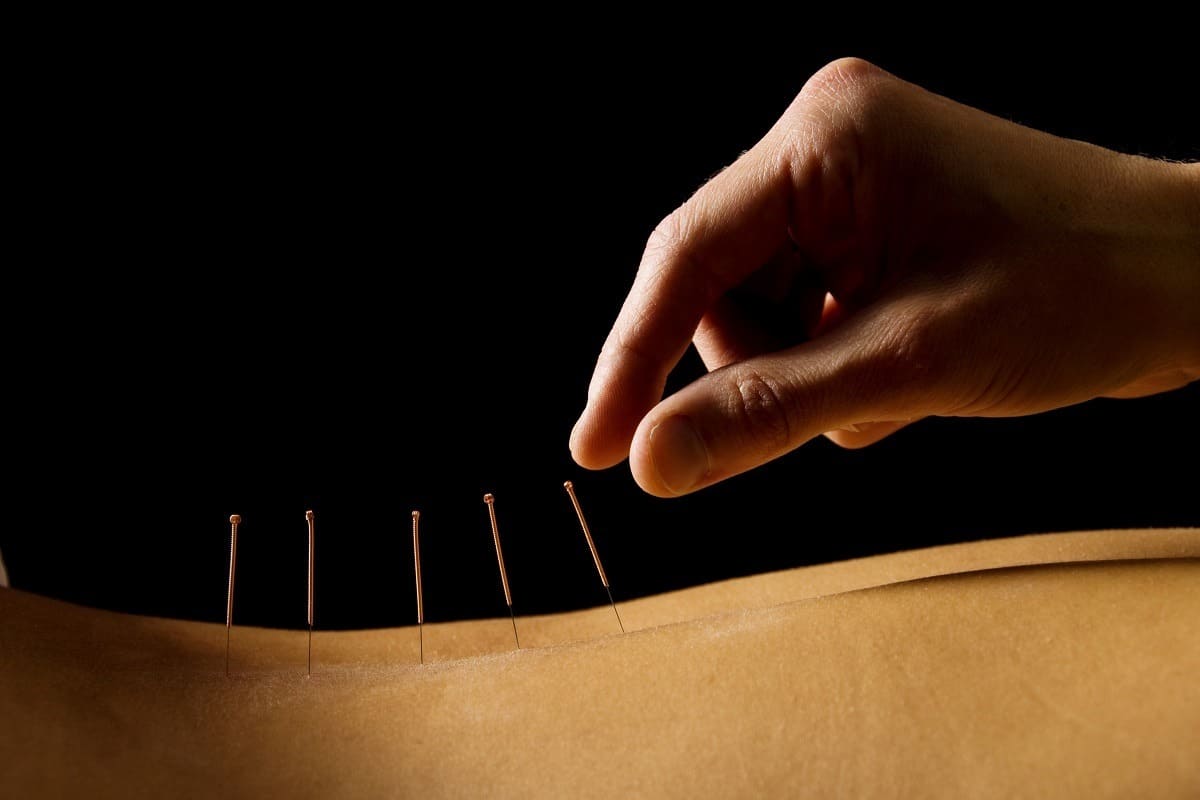 Un hombre haciendo acupuntura como terapias alternativas para el tratamiento de adicciones