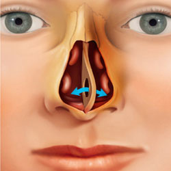 perforación del tabique nasal por consumo de cocaína